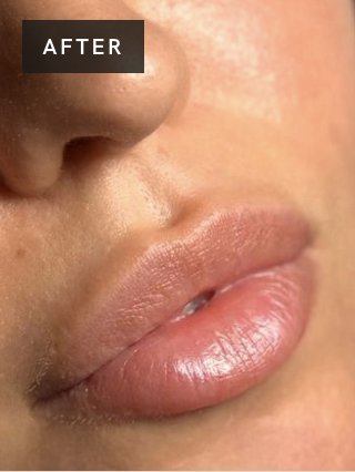 Treatment result after image