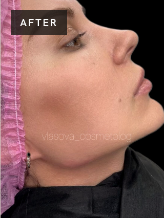 Treatment result after image