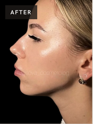 Treatment result after image